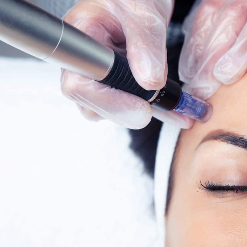 Morpheus8 treatment Ascot from Lipo Sculpt - Book in today!