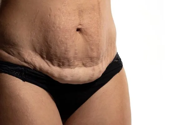 Lost the Weight but Not the Loose Skin? 1 image of womans stomach after weight loss showing loose skin Ascot